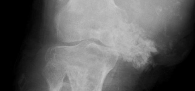 Sarkome in der Orthopädie und Sportmedizin